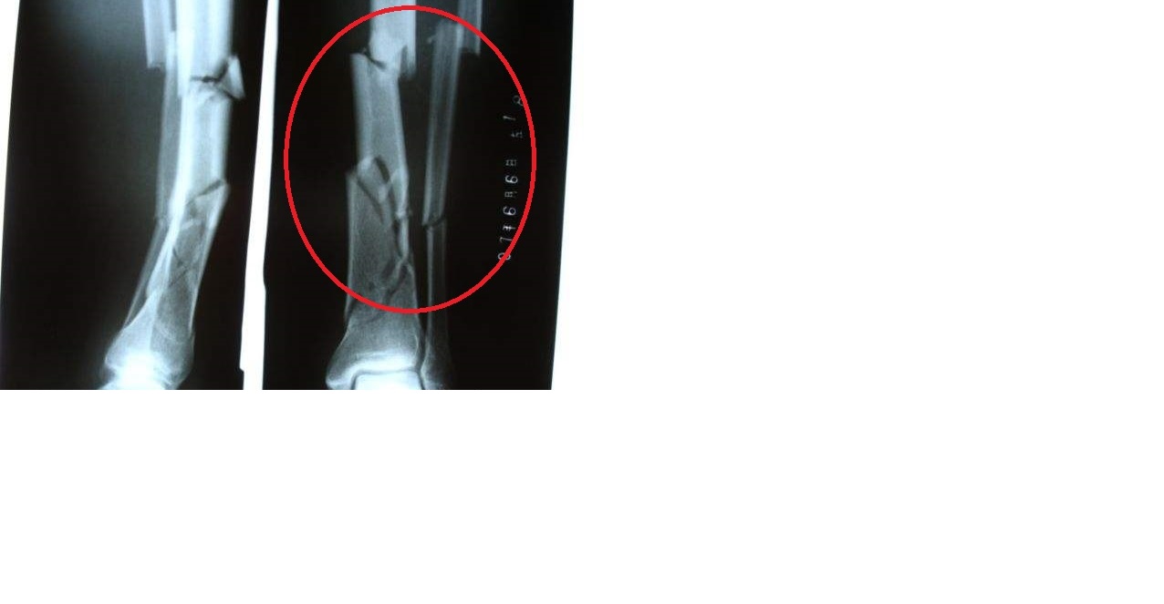 胫腓骨粉碎性骨折导致双下肢长度相差2cm以上.jpg